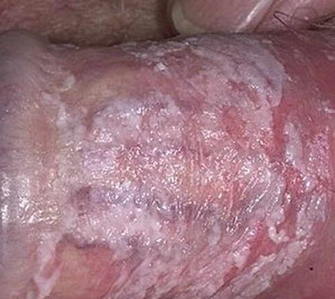 secreción cuajada cuando se excita
