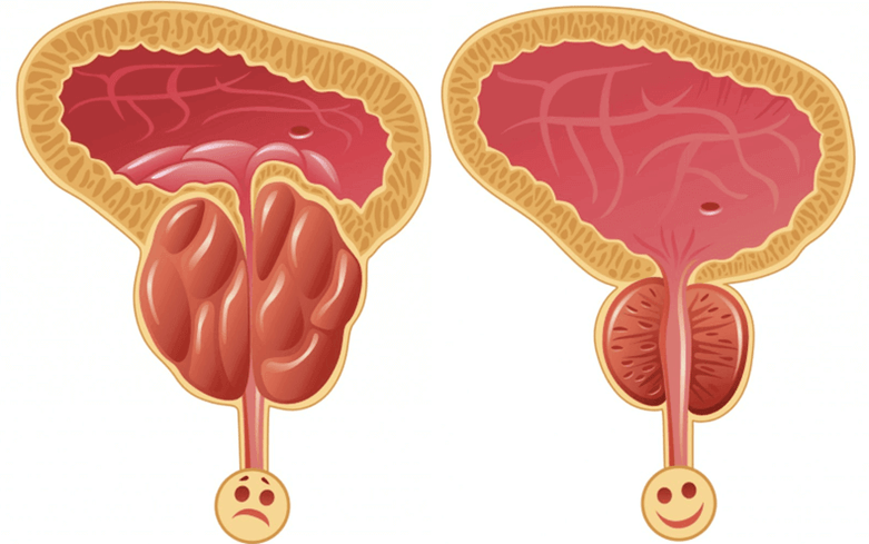 causas de los problemas de potencia en los hombres